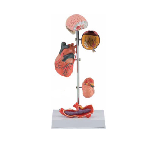 Effects of Hypertension 5 Parts