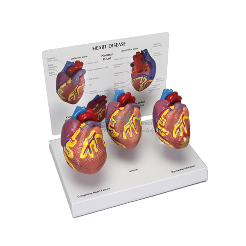 Heart Diseases Model