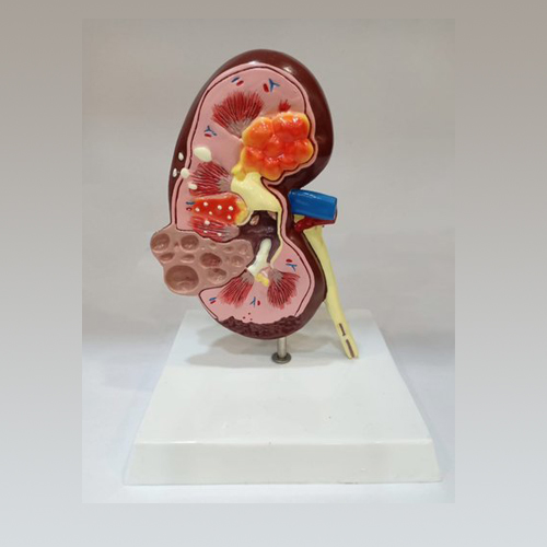 Pathological Model of Renal Calculus