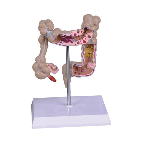 Pathological Model Of Colon & Rectum